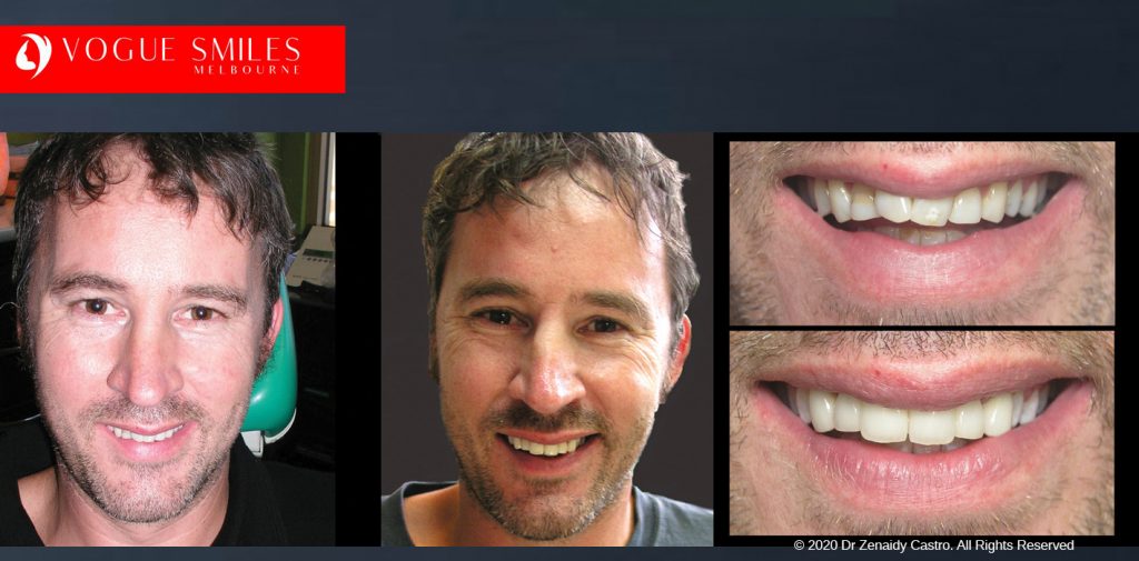 Before and After Smile Makeovers Melbourne - Australia's Top Cosmetic Dentist - VOGUE SMILES MELBOURNE