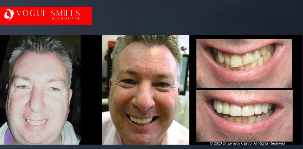 Before and After Smile Makeovers Melbourne - Australia's Top Cosmetic Dentist - VOGUE SMILES MELBOURNE