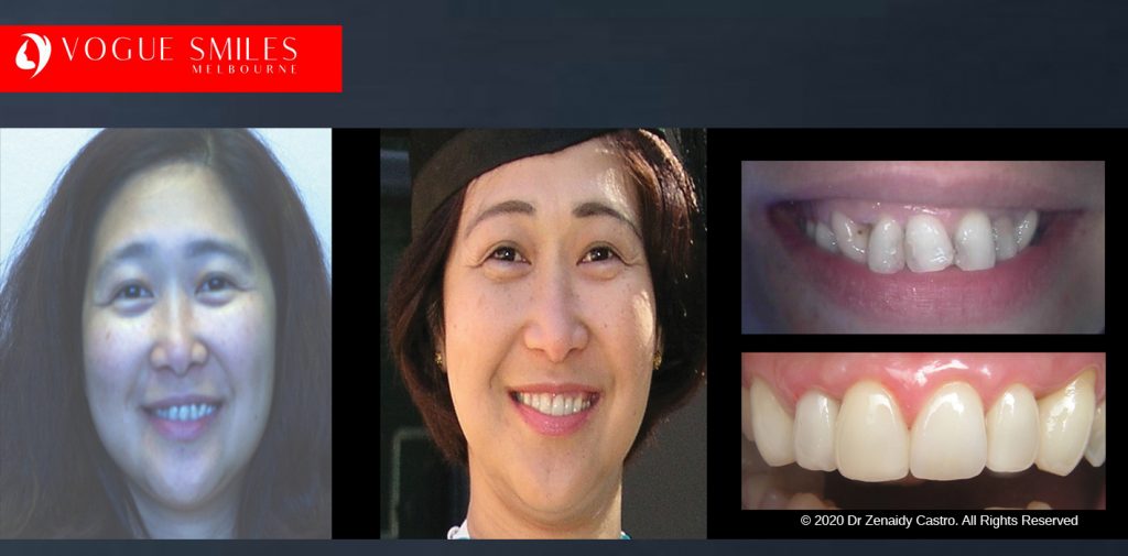 Before and After Smile Makeovers Melbourne - Australia's Top Cosmetic Dentist - VOGUE SMILES MELBOURNE