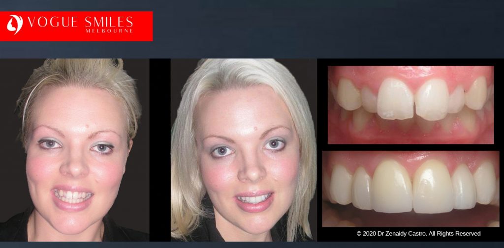 Before and After Smile Makeovers Melbourne - Australia's Top Cosmetic Dentist - VOGUE SMILES MELBOURNE