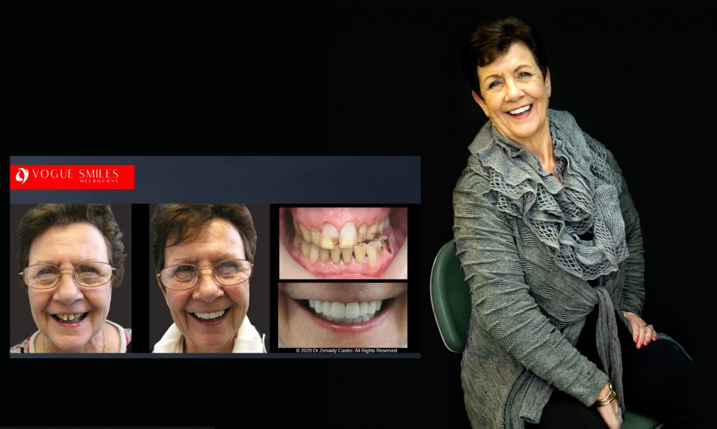 Cosmetic Dentistry Smile Makeovers Before and After Photos | Vogue Smiles Melbourne -Best Cosmetic Dentist Melbourne CBD