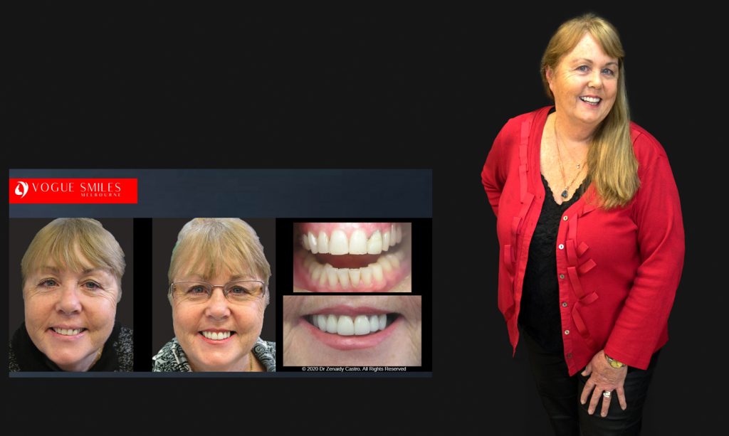 Cosmetic Dentistry Smile Makeovers Before and After Photos | Vogue Smiles Melbourne -Best Cosmetic Dentist Melbourne CBD