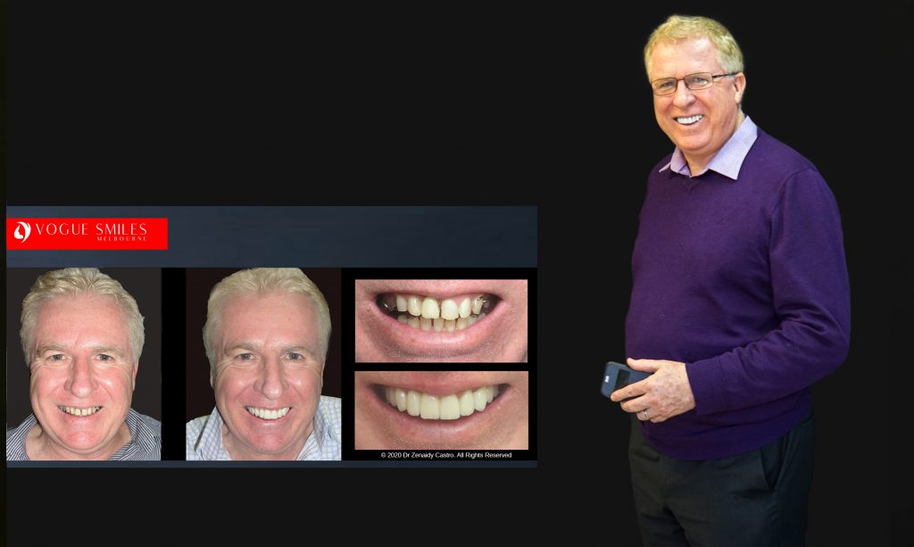 Cosmetic Dentistry Smile Makeovers Before and After Photos | Vogue Smiles Melbourne -Best Cosmetic Dentist Melbourne CBD