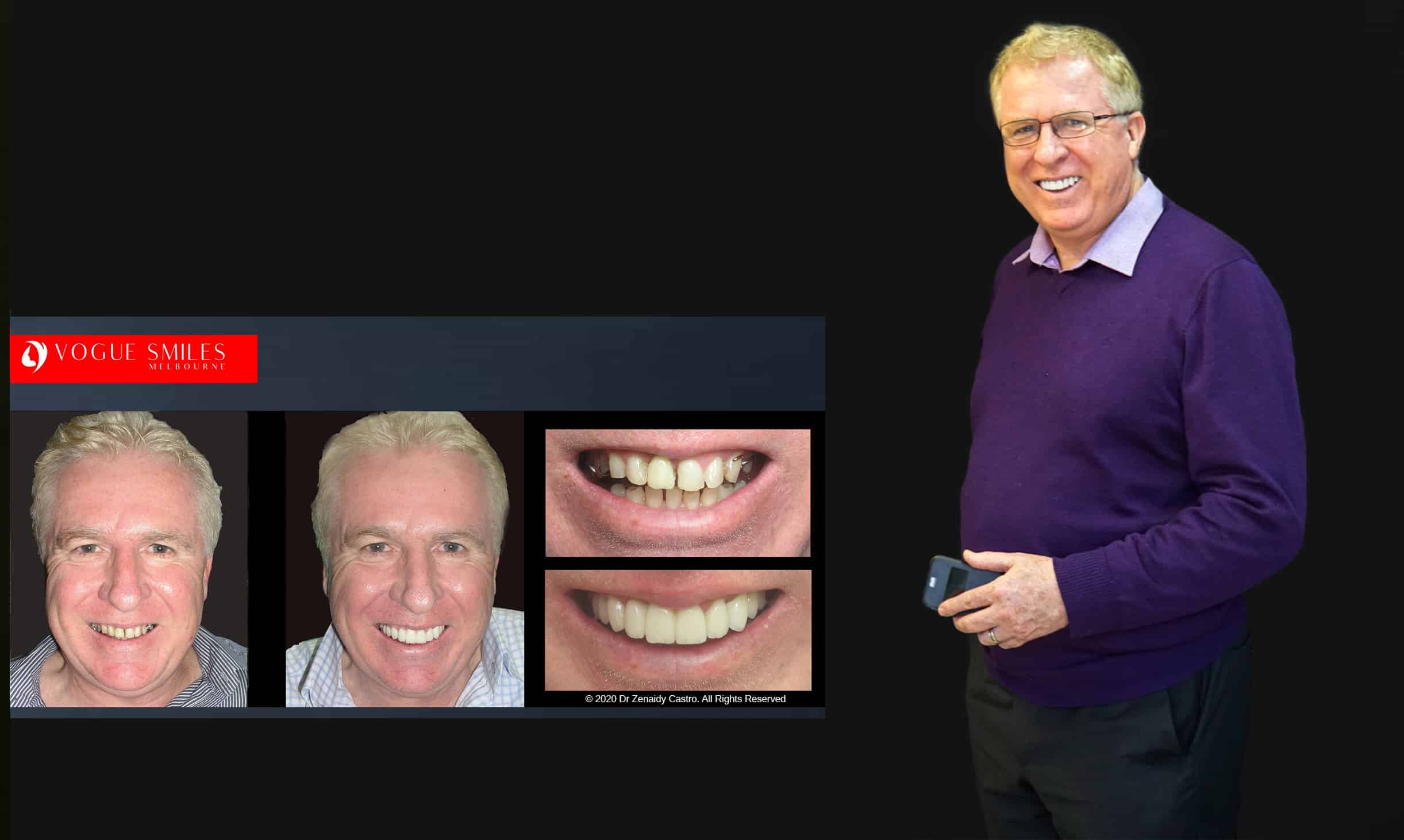 Before and After Smile Gallery | Australia's Top Cosmetic Dentistry | Vogue Smiles Melbourne -Best Cosmetic Dentist Melbourne CBD
