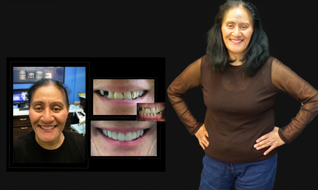 Cosmetic Dentistry Smile Makeovers Before and After Photos | Vogue Smiles Melbourne -Best Cosmetic Dentist Melbourne CBD