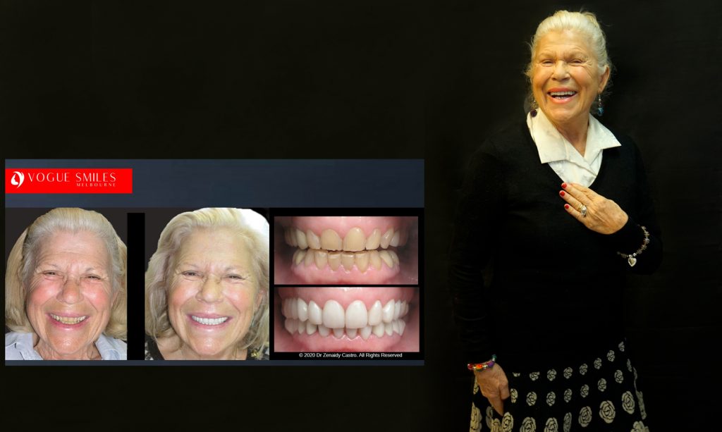 Cosmetic Dentistry Smile Makeovers Before and After Photos | Vogue Smiles Melbourne -Best Cosmetic Dentist Melbourne CBD