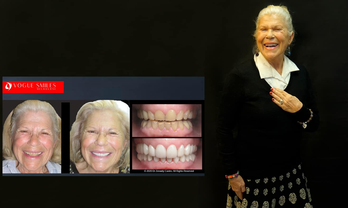 Beautiful Smiles with Lumineers Veneers Melbourne CBD | Dental Veneers Melbourne Beautiful Smiles with Lumineers Veneers Melbourne CBD | Dental Veneers Melbourne