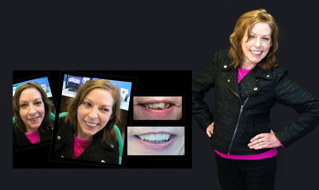 Cosmetic Dentistry Smile Makeovers Before and After Photos | Vogue Smiles Melbourne -Best Cosmetic Dentist Melbourne CBD