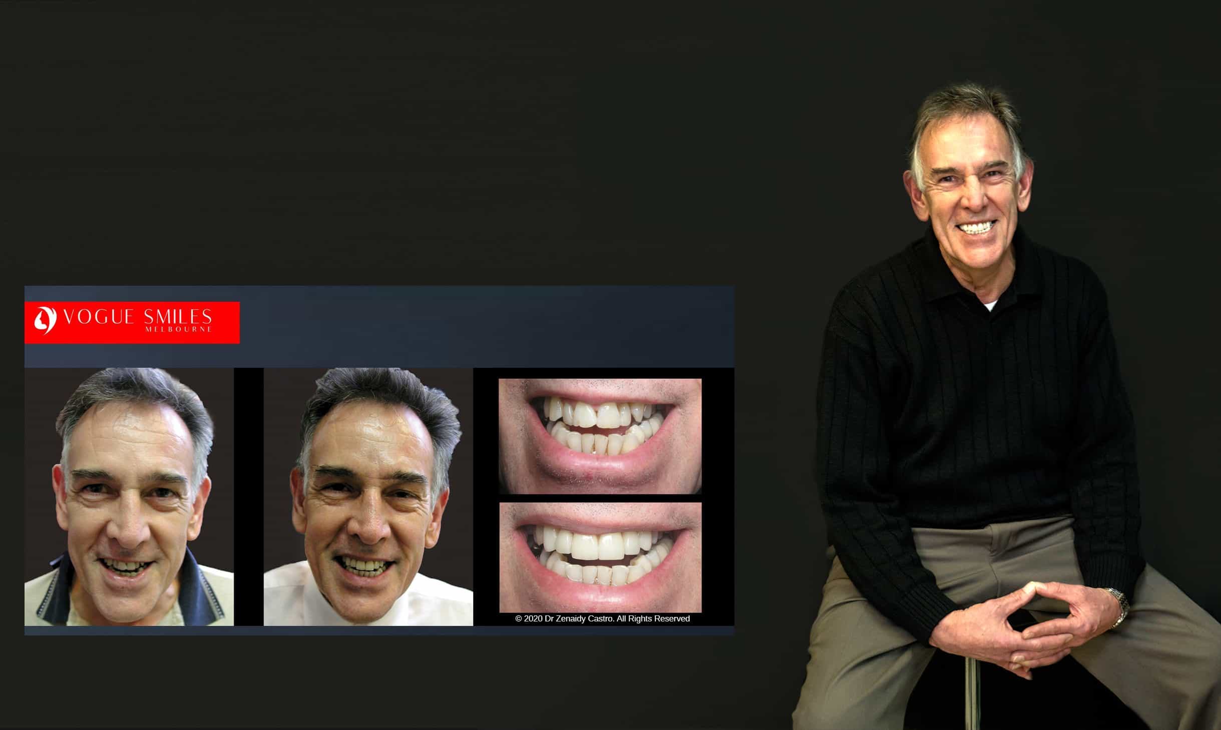 Before and After Smile Gallery | Australia's Top Cosmetic Dentistry | Vogue Smiles Melbourne -Best Cosmetic Dentist Melbourne CBD