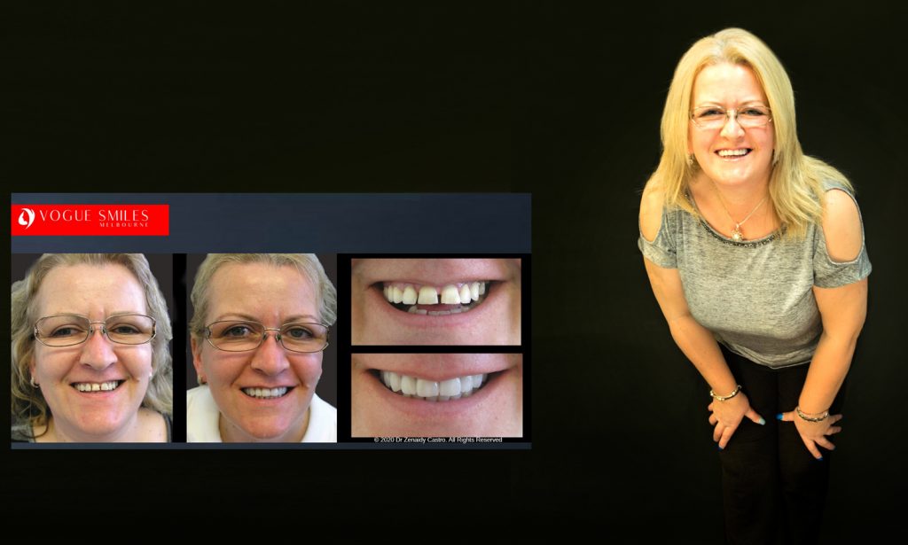 Cosmetic Dentistry Smile Makeovers Before and After Photos | Vogue Smiles Melbourne -Best Cosmetic Dentist Melbourne CBD