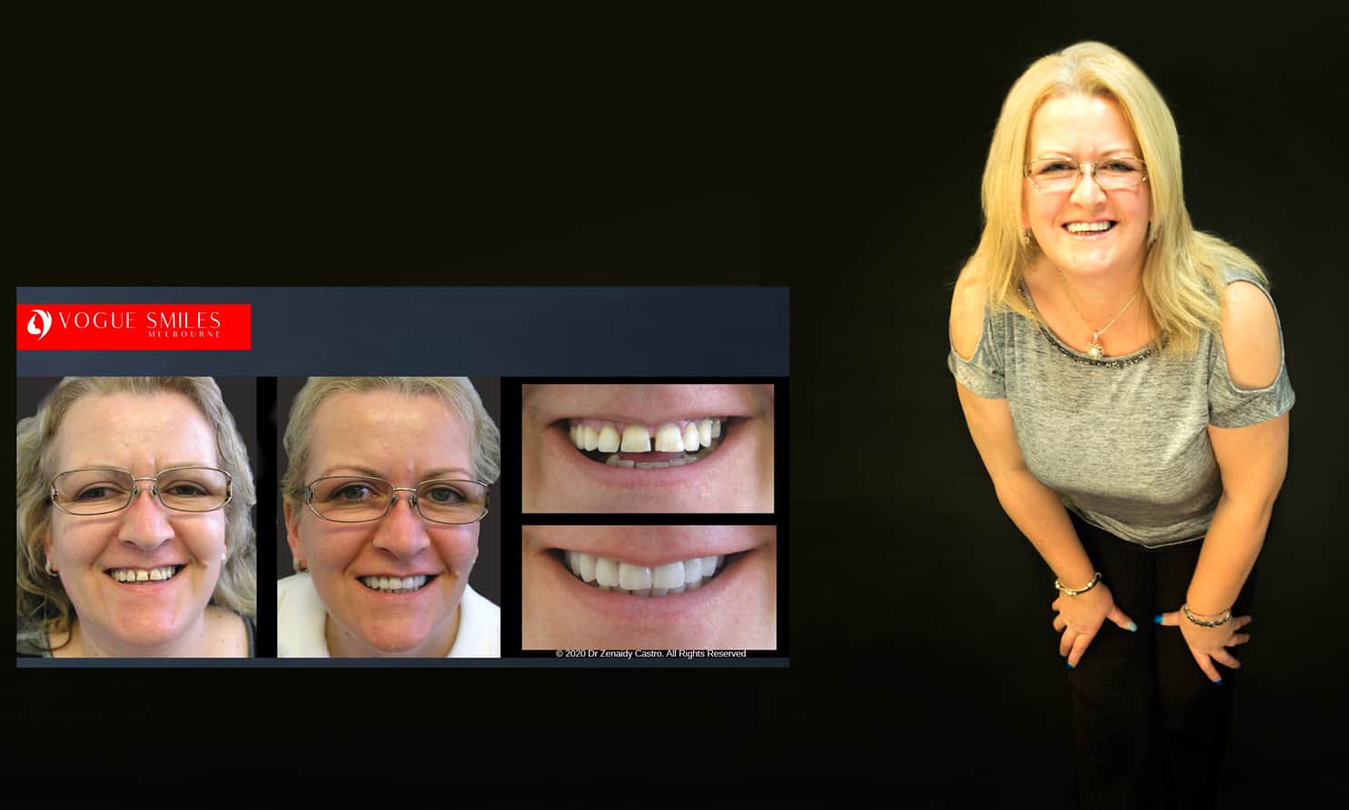 Beautiful Smiles with Lumineers Veneers Melbourne CBD | Dental Veneers Melbourne