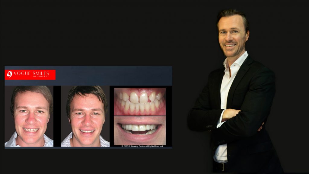 Cosmetic Dentistry Smile Makeovers Before and After Photos | Vogue Smiles Melbourne -Best Cosmetic Dentist Melbourne CBD