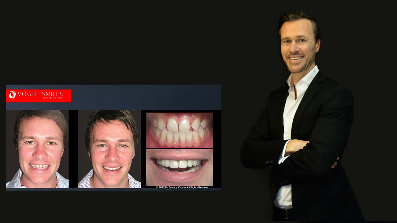 top cosmetic dentists near me | Cosmetic Dentist Melbourne | Best Cosmetic Dentistry Melbourne CBD | Best Veneers Dentist Melbourne Before and after -VOGUE SMILES MELBOURNE
