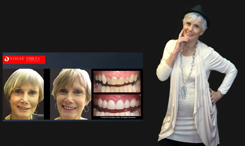 Cosmetic Dentistry Smile Makeovers Before and After Photos | Vogue Smiles Melbourne -Best Cosmetic Dentist Melbourne CBD