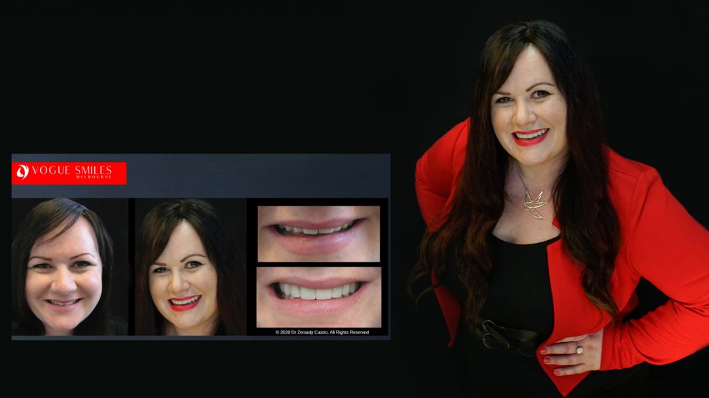 Cosmetic Dentistry Smile Makeovers Before and After Photos | Vogue Smiles Melbourne -Best Cosmetic Dentist Melbourne CBD