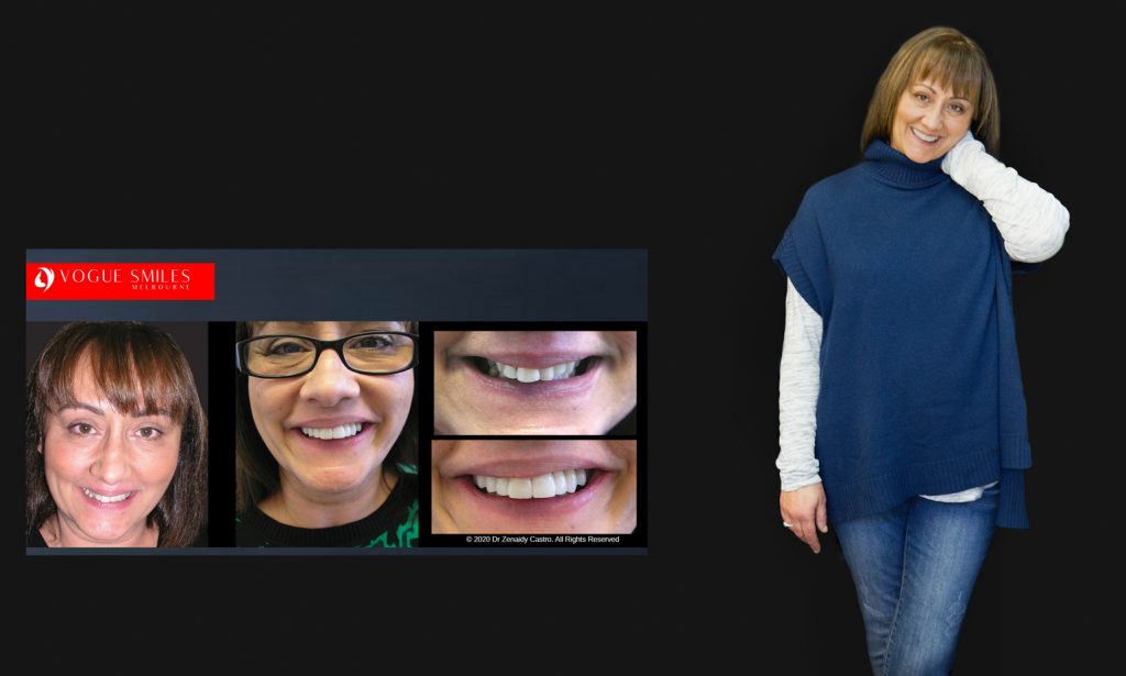 Cosmetic Dentistry Smile Makeovers Before and After Photos | Vogue Smiles Melbourne -Best Cosmetic Dentist Melbourne CBD