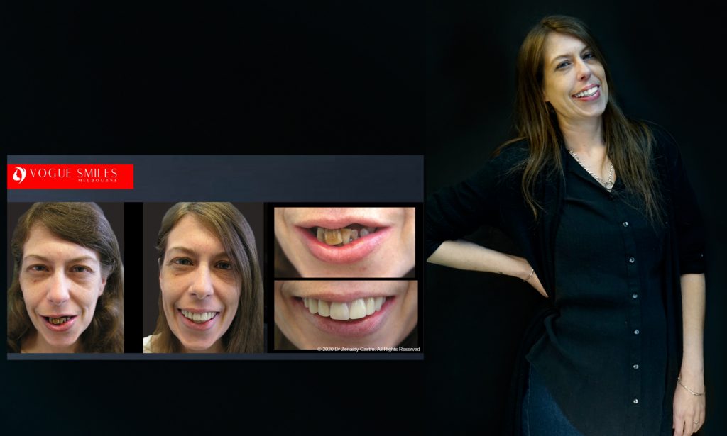Cosmetic Dentistry Smile Makeovers Before and After Photos | Vogue Smiles Melbourne -Best Cosmetic Dentist Melbourne CBD