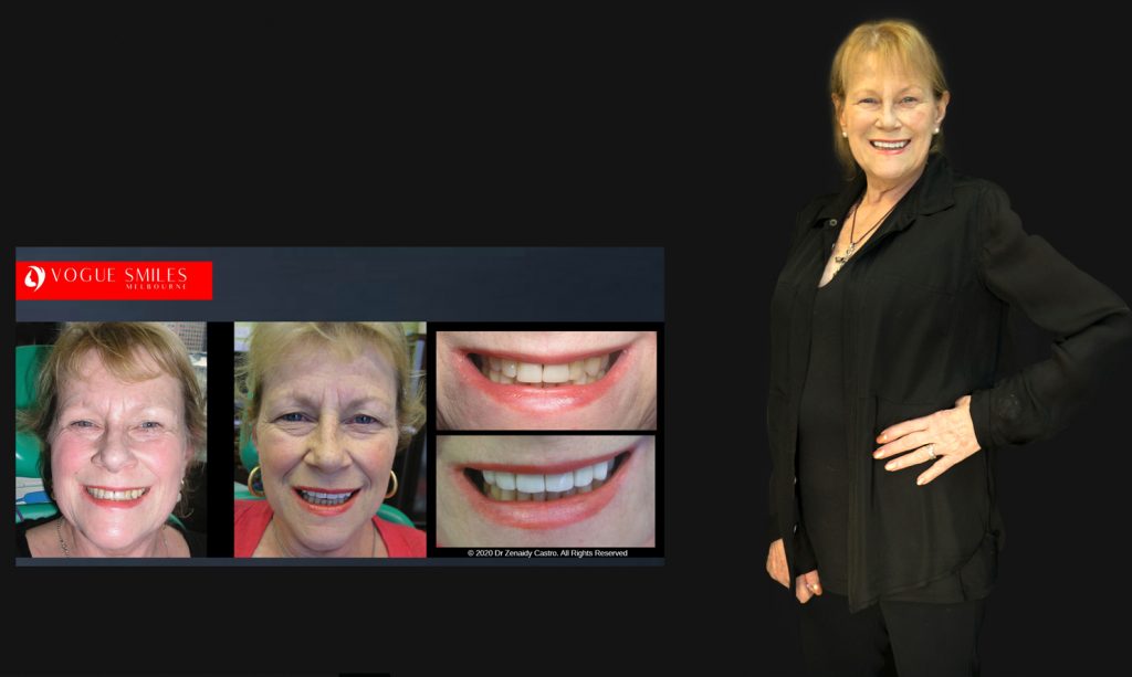 Cosmetic Dentistry Smile Makeovers Before and After Photos | Vogue Smiles Melbourne -Best Cosmetic Dentist Melbourne CBD