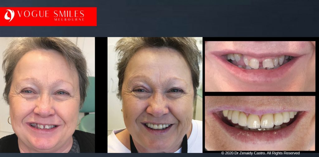 Closing Gaps Between Teeth Before & After Melbourne - Gappy Teeth Treatment in Melbourne