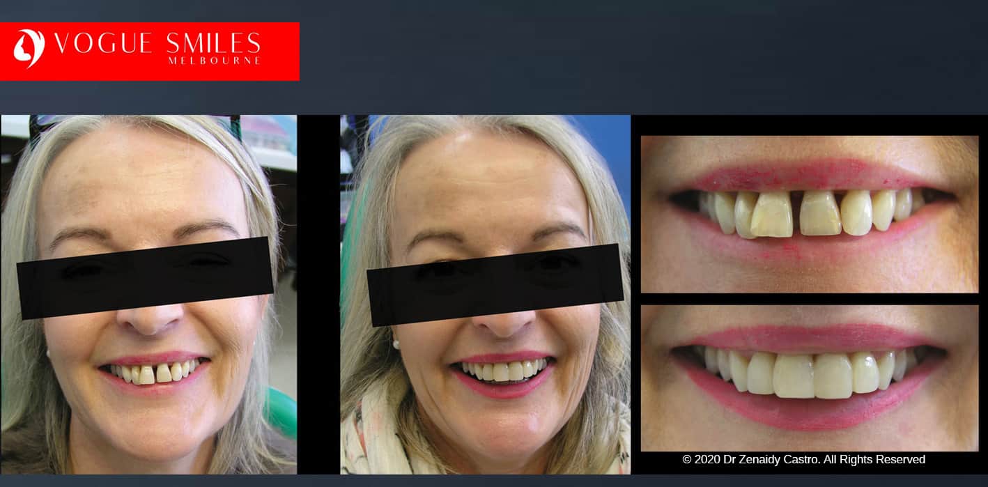 Gappy Teeth Treatment in Melbourne | Gappy Tooth | gap between teeth - Closing Gaps Between Teeth BEFORE AND AFTER PHOTOS
