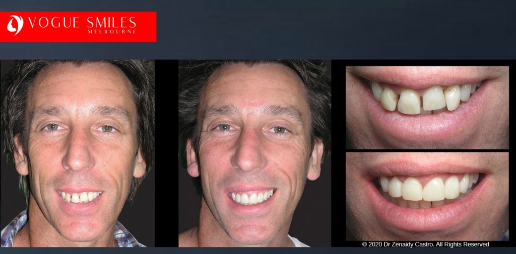Closing Gaps Between Teeth Before & After Melbourne - Gappy Teeth Treatment in Melbourne