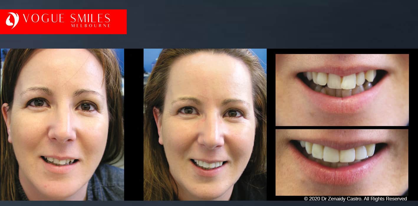 Dental Bonding Before and After Composite Veneers Gallery