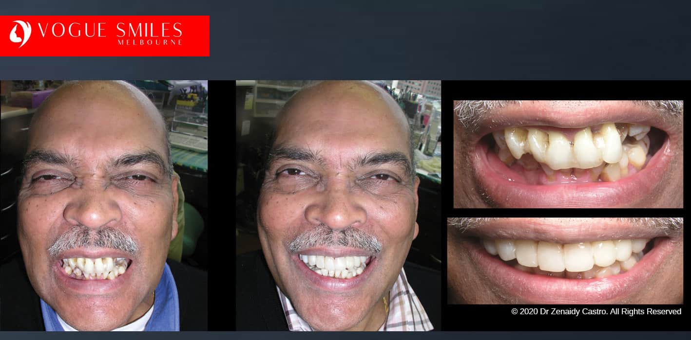 Dental Bonding Before and After Composite Veneers Gallery