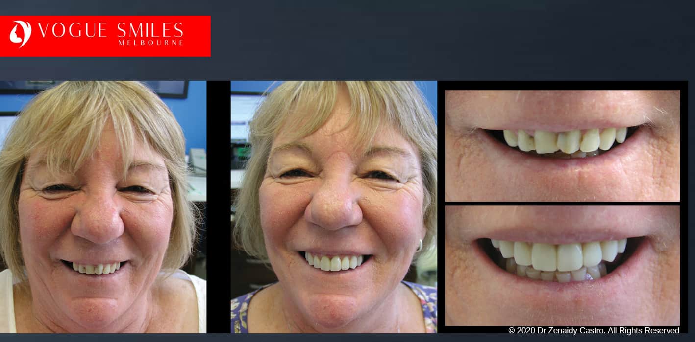 Dental Bonding Before and After Composite Veneers Gallery