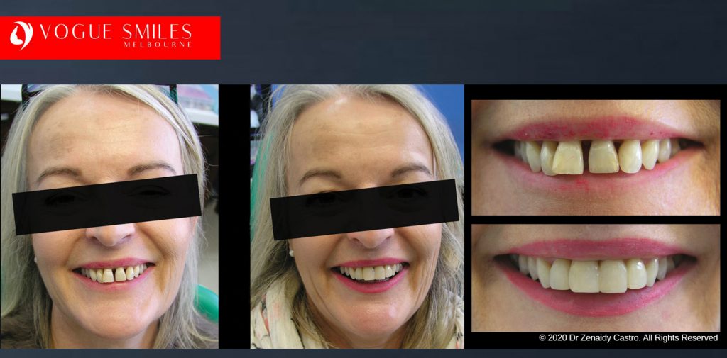 Dental Bonding Before and After Photos Melbourne | Composite Resin Veneers before and after pictures Melbourne CBD