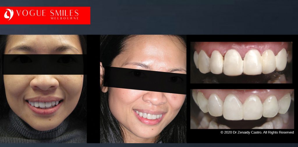 Dental Bonding Before and After Photos Melbourne | Composite Resin Veneers before and after pictures Melbourne CBD