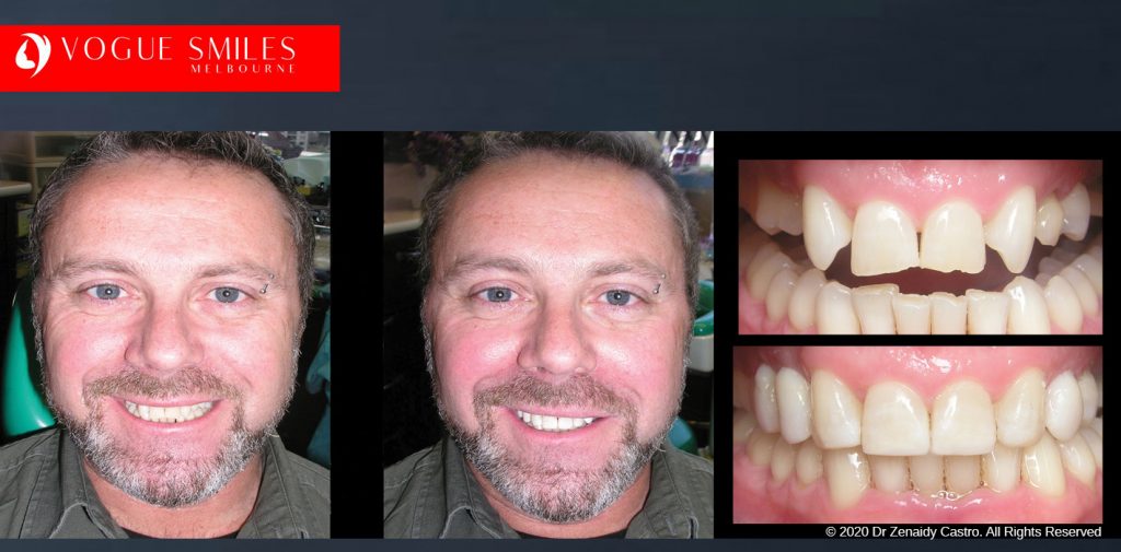 Dental Bonding Before and After Photos Melbourne | Composite Resin Veneers before and after pictures Melbourne CBD