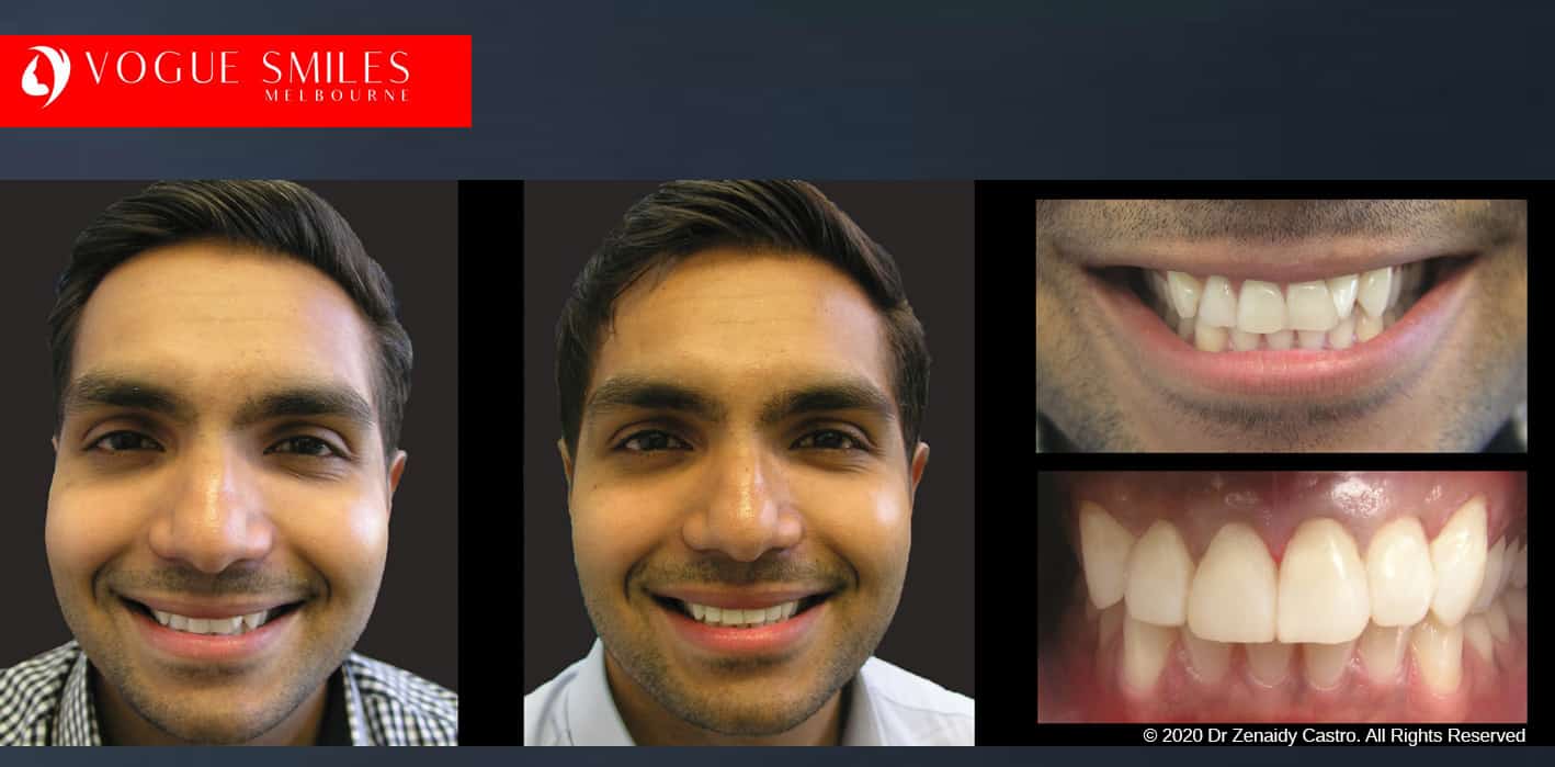 Dental Bonding Before and After Composite Veneers Gallery