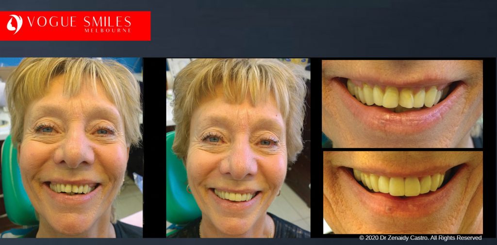 Dental Bonding Before and After Photos Melbourne | Composite Resin Veneers before and after pictures Melbourne CBD