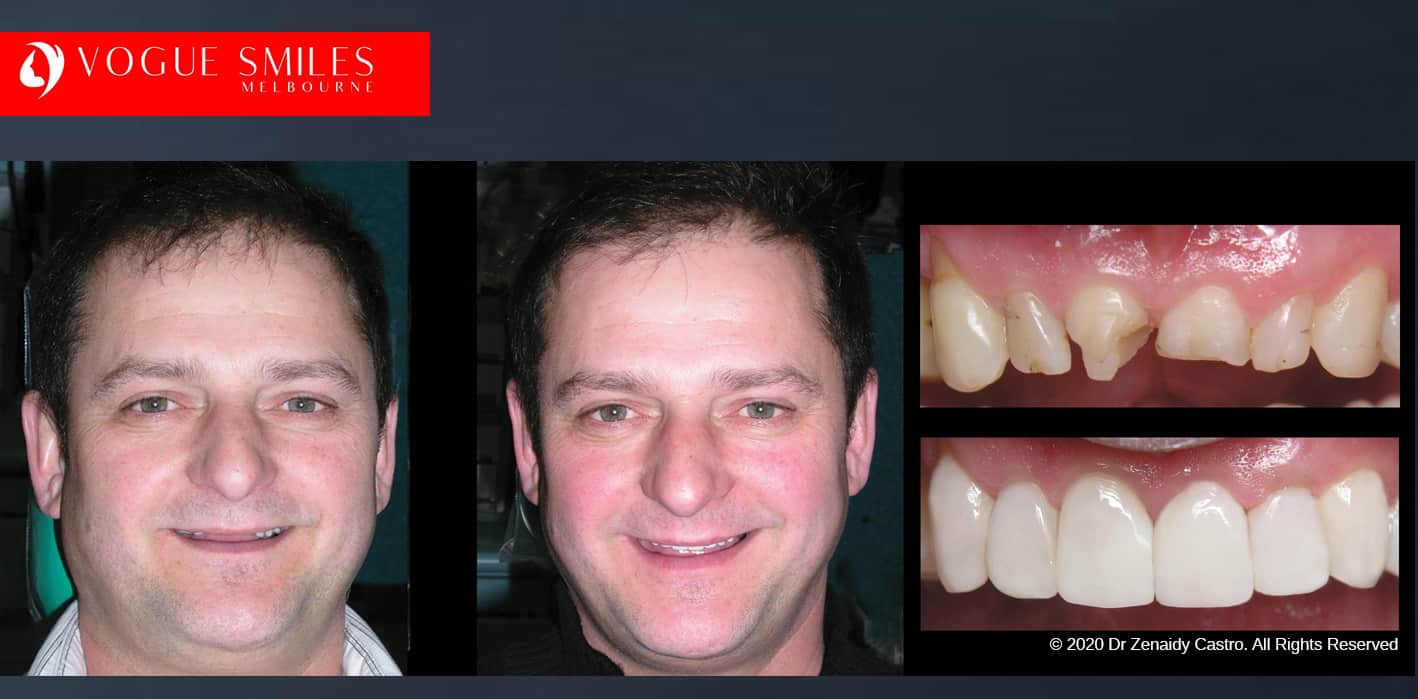 Dental Bonding Before and After Composite Veneers Gallery Dental Bonding Before and After Composite Veneers Gallery