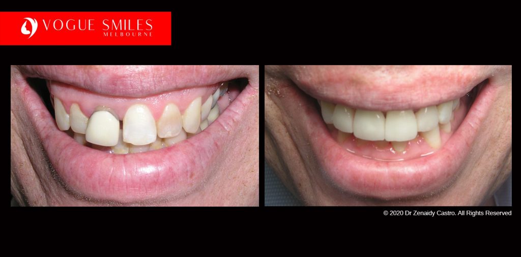 Full Mouth Reconstructions Melbourne Before and After