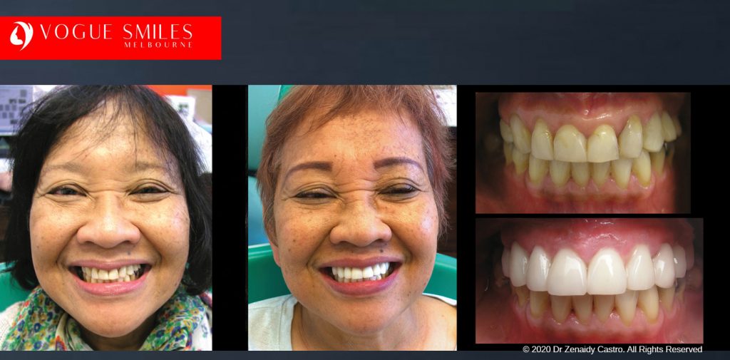 Worn and Flattened Front Teeth, Small Teeth Before and After Melbourne - BEST COSMETIC DENTIST IN MELBOURNE