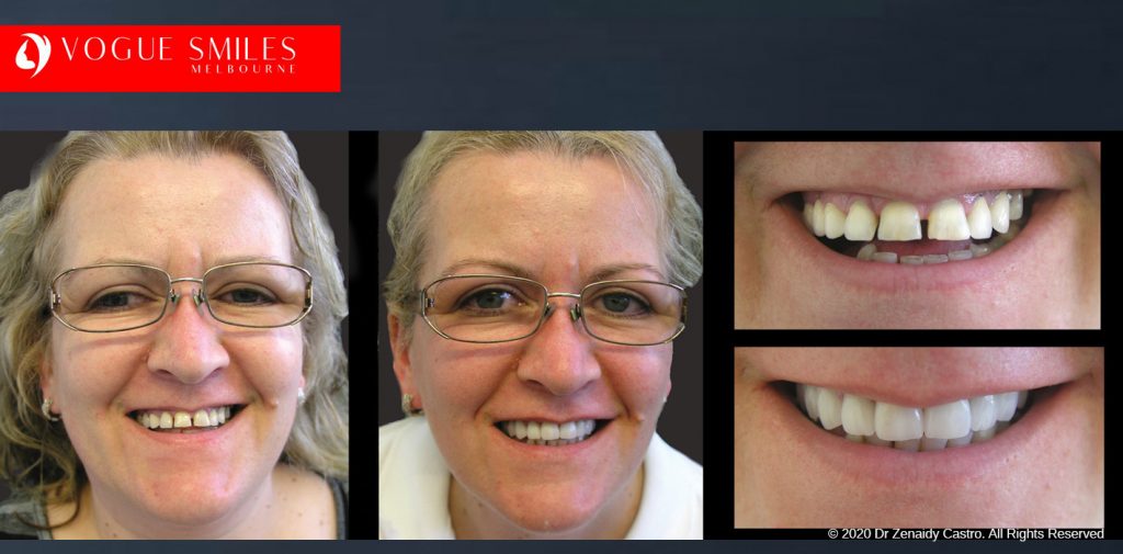 Worn and Flattened Front Teeth, Small Teeth Before and After Melbourne - BEST COSMETIC DENTIST IN MELBOURNE