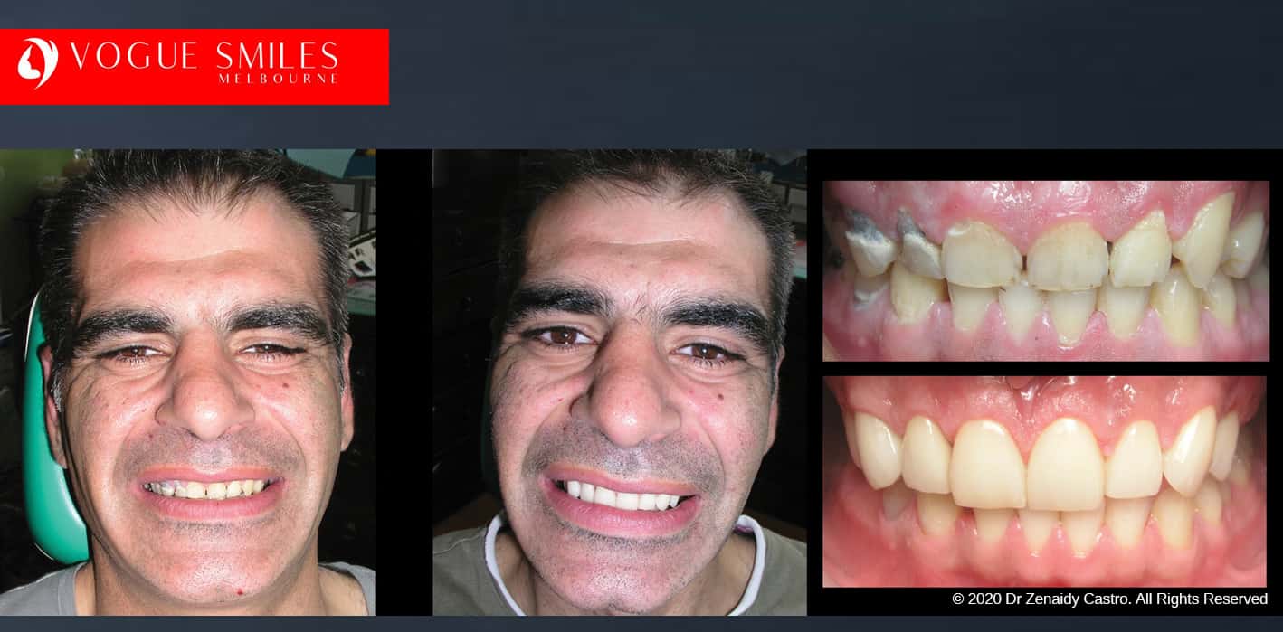 Short Teeth before and after photos, Small Teeth before and after photos, Worn-down Teeth before and after photos