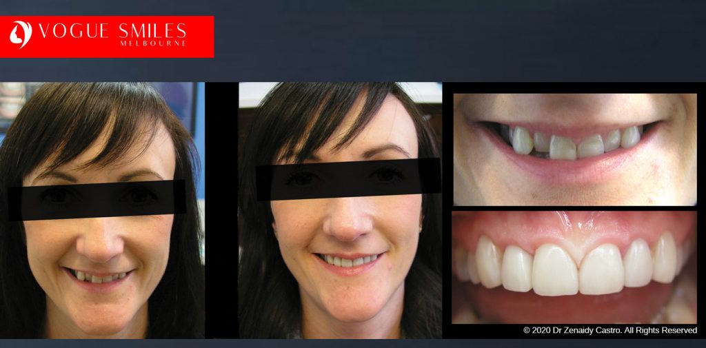 Worn and Flattened Front Teeth, Small Teeth Before and After Melbourne - BEST COSMETIC DENTIST IN MELBOURNE