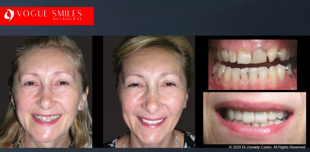 Worn and Flattened Front Teeth, Small Teeth Before and After Melbourne - BEST COSMETIC DENTIST IN MELBOURNE