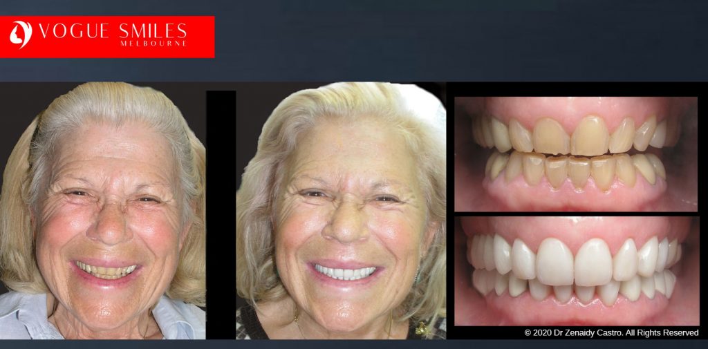 Worn and Flattened Front Teeth, Small Teeth Before and After Melbourne - BEST COSMETIC DENTIST IN MELBOURNE