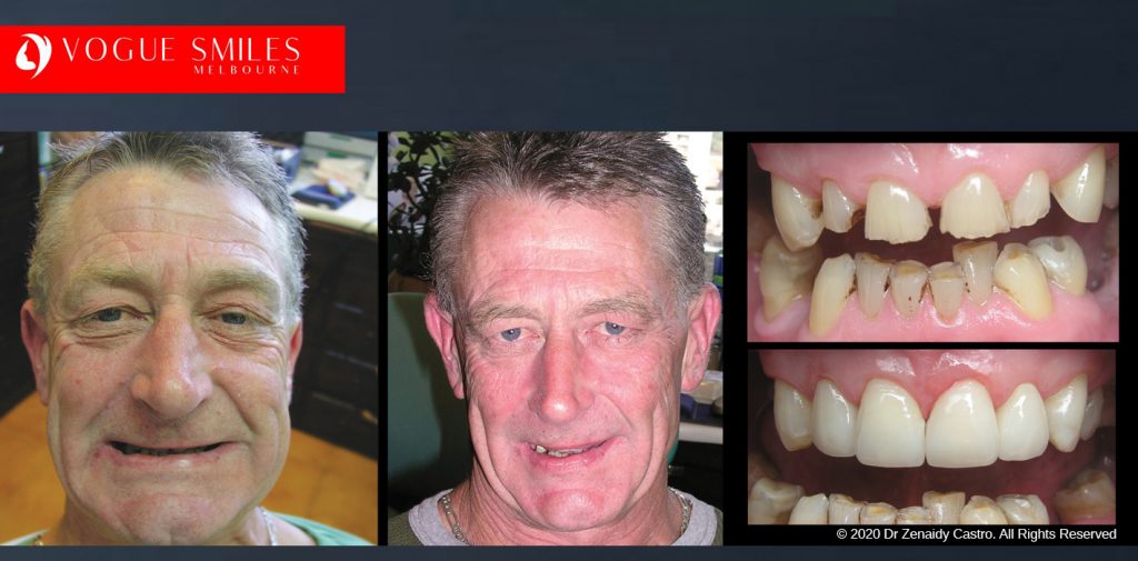 Worn and Flattened Front Teeth, Small Teeth Before and After Melbourne - BEST COSMETIC DENTIST IN MELBOURNE