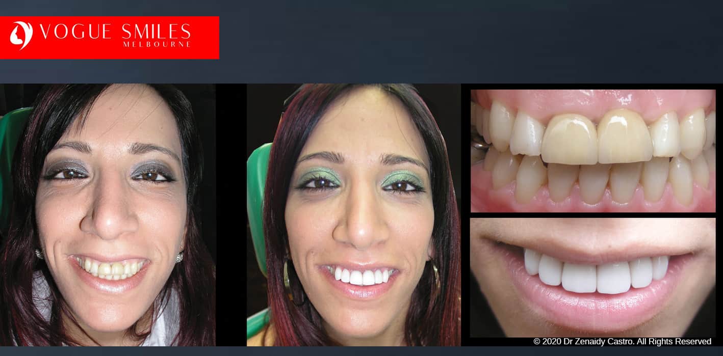 Uneven Bite Treatment in Melbourne, Fix Small, short, worn down, uneven, cracked , chipped smiles teeth with Dental Veneers before and after Melbourne