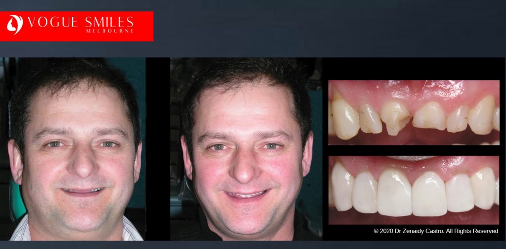 Worn and Flattened Front Teeth, Small Teeth Before and After Melbourne - BEST COSMETIC DENTIST IN MELBOURNE