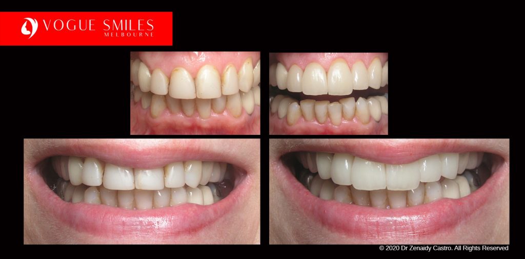 Full Mouth Reconstructions Melbourne Before and After