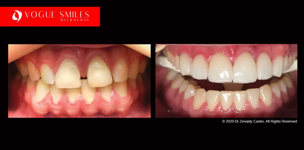 Full Mouth Reconstruction Before and After