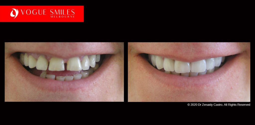 Full Mouth Reconstructions Melbourne Before and After