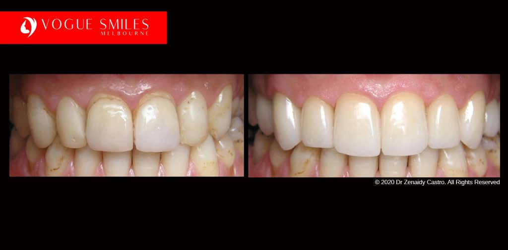 Full Mouth Reconstruction Before and After