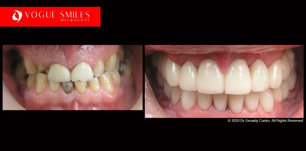 Full Mouth Reconstructions Melbourne Before and After