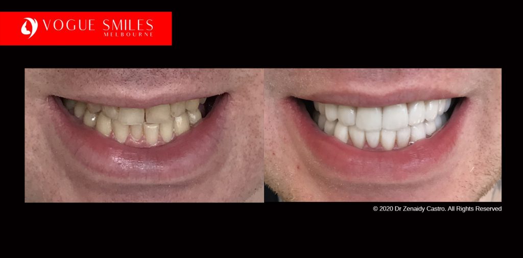 Full Mouth Reconstruction Before and After